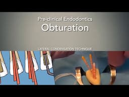 Obturation (Lateral Condensation Technique)
