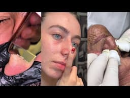 10 Minutes Of Top ASMR Pimple Popping Video