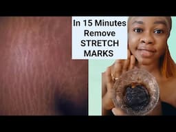 In 15 Minutes Remove All Stretch Marks at Home Fast and Naturally#diyskincare #stretchMarks #fyp