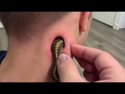 He has a snake stuck in his neck when wife saw it she called the officials