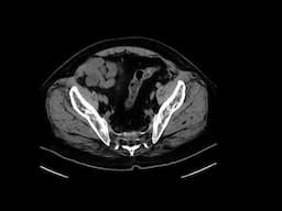 Appendix Mucocele