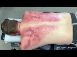 It's *Shocking* 😱 How Purple His Back Gets...Cracks & Gua Sha Clean Muscles And Joints!!