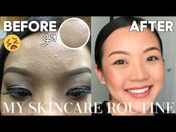 CLEAR YOUR SKIN FAST!! EVERYTHING YOU NEED TO KNOW ABOUT A SKINCARE ROUTINE│MY SKINCARE ROUTINE