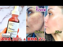 The Ordinary AHA BHA Peeling Solution Review | MAGIC in a Bottle🤔