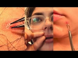 12 Minutes Of Top ASMR Pimple Popping Video