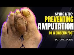 Saving A Toe: Preventing Amputation In A Diabetic