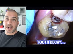 Monster Tooth Decay under Dental Bridge {Procedure Review}