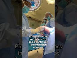 Probing a diabetic foot ulcer #feet #podiatry #diabetes #diabeticfoot  #footsurgery #limbsalvage