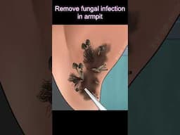 Remove fungal infection in armpit #asmr #brainasmr #makeupanimation