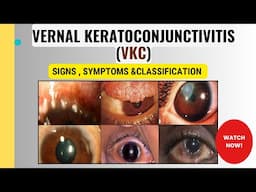 Vernal Keratoconjunctivitis (VKC) | Clinical features, Pathophysiology, and Grading