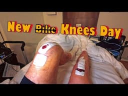 Transforming My Life With Bilateral Unicompartmental Knee Surgery!