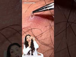 SUBSCRIBE for skincare - Dr Vanita Rattan #ingrownhair