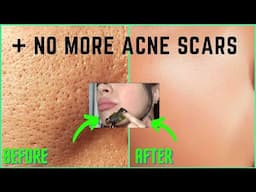 How To Get Rid Of ACNE SCARS + LARGE PORES PERMANENTLY [100% Works] All Natural Glass Skin DIY