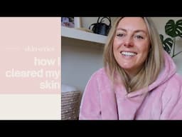 how i cleared my skin | my journey with acne & rosacea