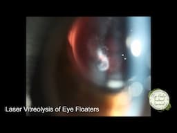 INACCESSIBLE EYE FLOATERS? USING A MIRRORED LENS