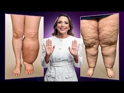 Lipedema x Linfedema Melhor forma de identificar na hora da Massagem