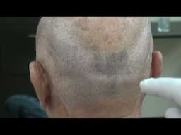 Hair Loss Treatment for Men | [Type of transplant] (# Hair grafts)