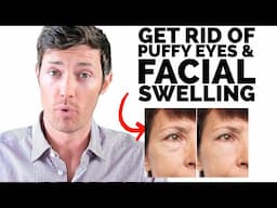 Get Rid of Thyroid Puffy Eyes & Facial Swelling