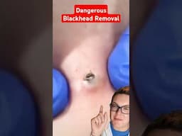 Dangerous BLACKHEAD REMOVAL - Why You Have To Wear Gloves #shorts