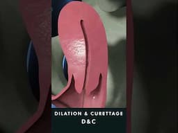 Dilation and Curettage D&C animation #uterinecancer #treatment