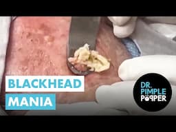 Blackhead Mania