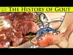 Gout - The Disease of Kings