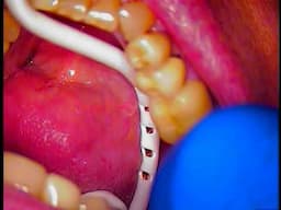 DENTAL IMPLANT RESCUE - REMOVAL OF A BROKEN ABUTMENT AND SCREW BY DR. GERRY CUOMO