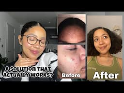 HOW MICRONEEDLING CLEARED MY SKIN + DIET TIPS