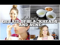 NATURALLY GET RID OF BLACKHEADS AND ACNE | Mandi Makes