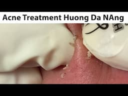 Acne Treatment Huong Da Nang# 719#Merry Christmas 2024