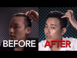 Hair Transplant in Korea Results After 1 Year