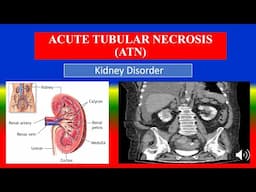 ACUTE TUBULAR NECROSIS (ATN) - Definition, types, causes, pathophysiology,  diagnoses , medicine