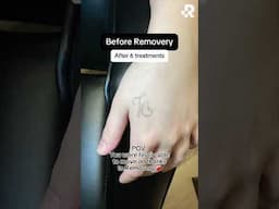 Tattoo Removal Results at Removery😍