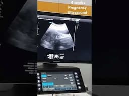 What does the 4 Week Pregnancy Scan look like? A Pregnancy Clinic case study #ultrasound