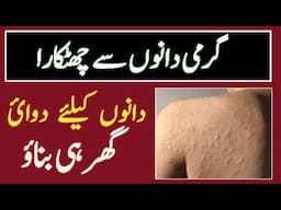 Garmi dano ka ilaj || Prickly Heat Treatment