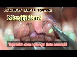 Cara Menghilangkan Batu Amandel / Tonsil stone  | Hempaskan Bau Jigong! #hempasbaujigong