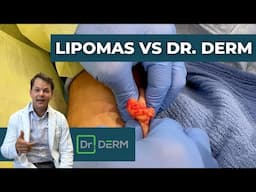 Lipomas vs Dr. Derm! | Dr. Derm