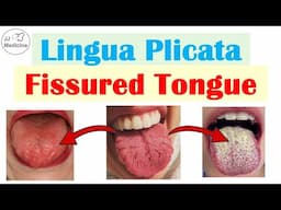 Lingua Plicata (Fissured, Grooved Tongue) | Causes, Complications, Treatment