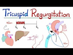 Tricuspid Regurgitation (TR) - Valvular Heart Disease (VHD) - Tricuspid Valve Insufficiency - Cardio