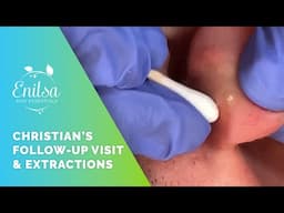 Christian Comes Back for More Blackhead Extractions!