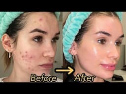 How I Finally Cleared My Acne and Textured Skin! *Hormonal Acne Skincare Routine*