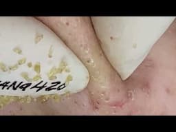 Loan Nguyen Acne Treatment 35r