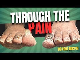 Through The Pain: Trimming Fungal Toenails