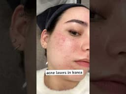 gifted || acne treatments in seoul