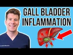 Doctor explains Acute Cholecystitis (Gall bladder inflammation) | Causes, symptoms, treatment & more