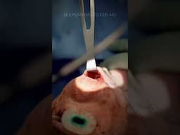 Bilateral Submandibular Gland Resection