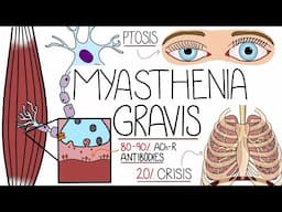 Myasthenia Gravis Explained Clearly