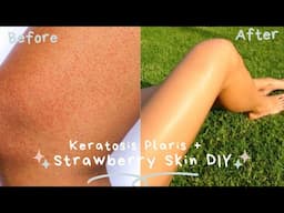 GET RID OF STRAWBERRY LEGS + KERATOSIS PILARIS + DARK SPOT REMOVAL [My At Home Remedy Cure + DIY]