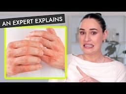 What to do if you have eczema! | An Expert's guide to skincare for eczema and dermatitis face & skin