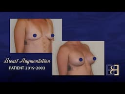 400cc Silicone Round Breast Implants (Augmentation Mammaplasty) {Patient 2019-2003} Before & After